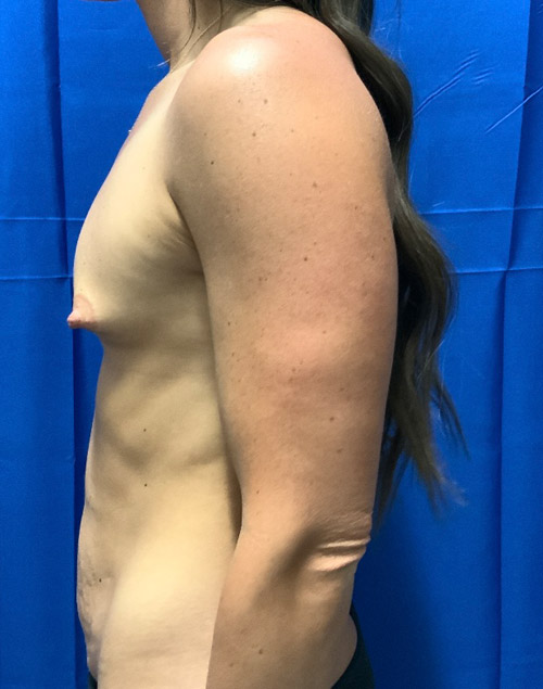 34 year-old one year after abdominoplasty and 1 month after revision of her breast augmentation with 470 cc high profile silicone gel smooth round Sientra implants