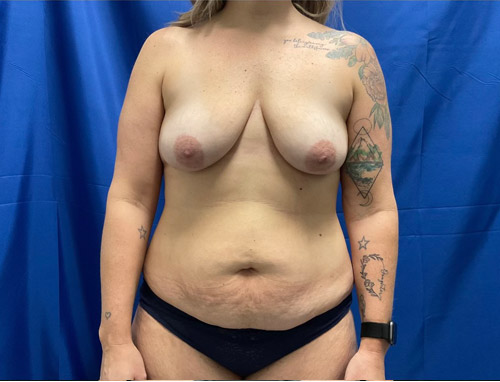 41 year old 3 months sp full abdominoplasty with liposuction of the upper abdomen and flanks and in addition she has smooth Sientra Moderate profile implants with a breast lift. She has been consistent with her postoperative diet and followed instructions and her results speak for themselves.