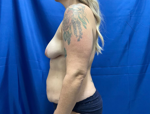 41 year old 3 months sp full abdominoplasty with liposuction of the upper abdomen and flanks and in addition she has smooth Sientra Moderate profile implants with a breast lift. She has been consistent with her postoperative diet and followed instructions and her results speak for themselves.