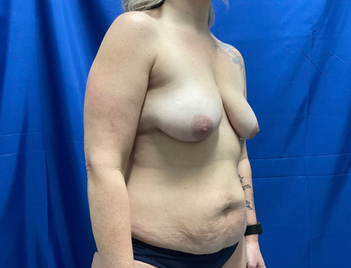 41 year old 3 months sp full abdominoplasty with liposuction of the upper abdomen and flanks and in addition she has smooth Sientra Moderate profile implants with a breast lift. She has been consistent with her postoperative diet and followed instructions and her results speak for themselves.