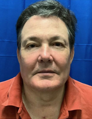 62 year old male 3 months after deep plane neck lift, temporal eyebrow lift and upper blepharoplasty