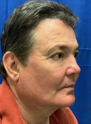 62 year old male 3 months after deep plane neck lift, temporal eyebrow lift and upper blepharoplasty