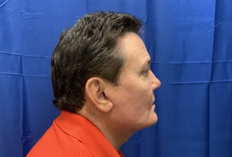 62 year old male 3 months after deep plane neck lift, temporal eyebrow lift and upper blepharoplasty