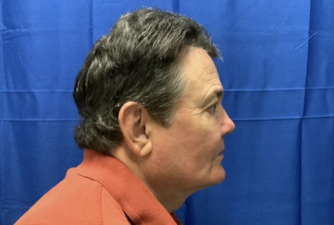 62 year old male 3 months after deep plane neck lift, temporal eyebrow lift and upper blepharoplasty