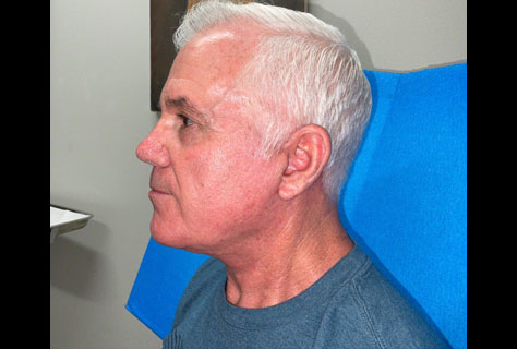 This very pleasant 62-year-old gentleman is shown before and 2 months after a neck lift procedure. Neck lift was done through an incision under the chin and in front of the ears. Patient is very happy with his rejuvenated neck as are we.