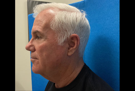 This very pleasant 62-year-old gentleman is shown before and 2 months after a neck lift procedure. Neck lift was done through an incision under the chin and in front of the ears. Patient is very happy with his rejuvenated neck as are we.