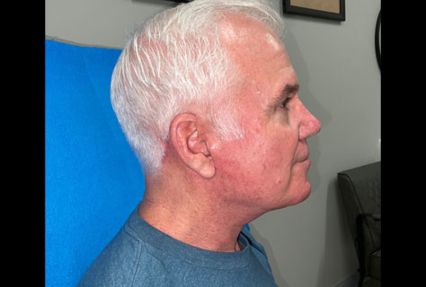 This very pleasant 62-year-old gentleman is shown before and 2 months after a neck lift procedure. Neck lift was done through an incision under the chin and in front of the ears. Patient is very happy with his rejuvenated neck as are we.