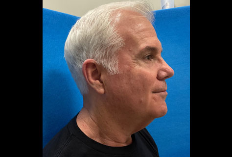 This very pleasant 62-year-old gentleman is shown before and 2 months after a neck lift procedure. Neck lift was done through an incision under the chin and in front of the ears. Patient is very happy with his rejuvenated neck as are we.