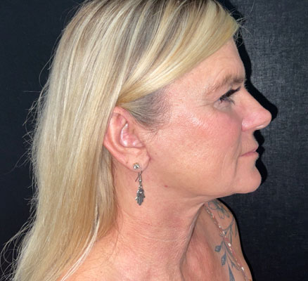 Neck lift before and after patient image2