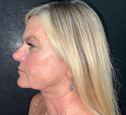 Neck lift before and after patient image3