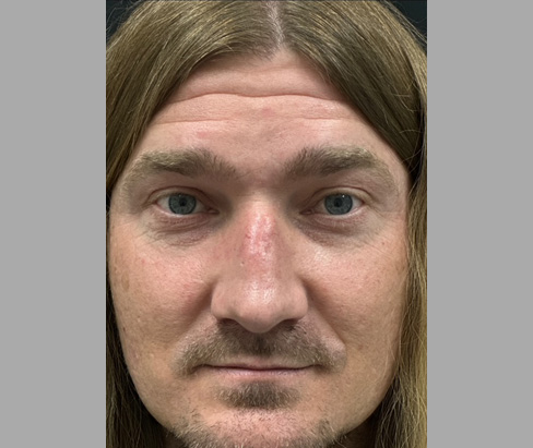 42 year old male 7 months after rhinoplasty