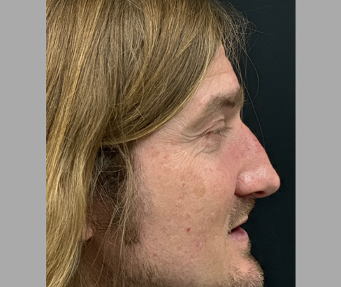 42 year old male 7 months after rhinoplasty