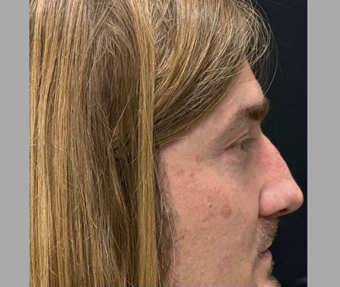 42 year old male 7 months after rhinoplasty 42 year old male 7 months after rhinoplasty