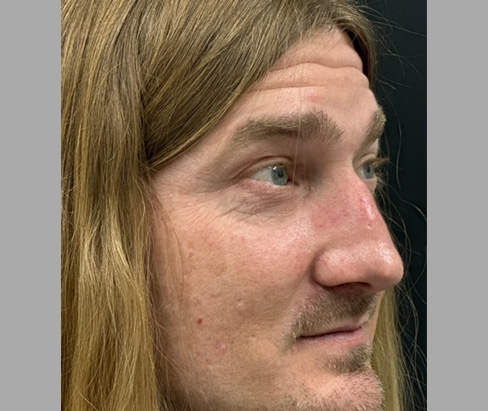42 year old male 7 months after rhinoplasty