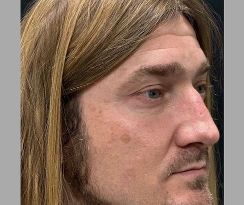 42 year old male 7 months after rhinoplasty 42 year old male 7 months after rhinoplasty