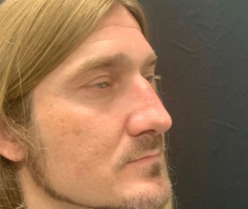 42 year old male shown 3 months sp closed rhinoplasty 42 year old male shown 3 months sp closed rhinoplasty