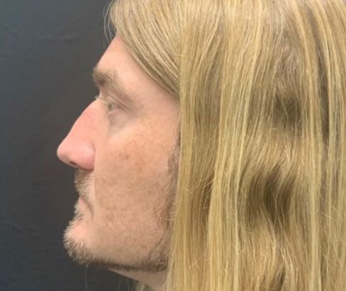 42 year old male shown 3 months sp closed rhinoplasty 42 year old male shown 3 months sp closed rhinoplasty