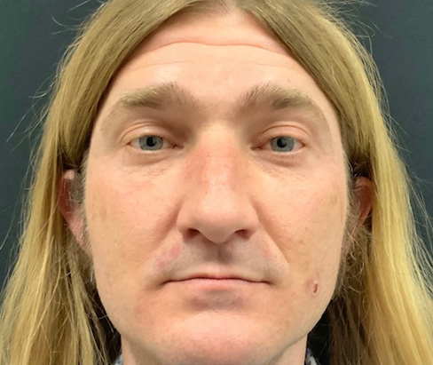 42 year old male 7 months after rhinoplasty