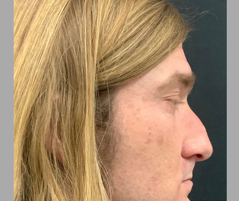 42 year old male 7 months after rhinoplasty