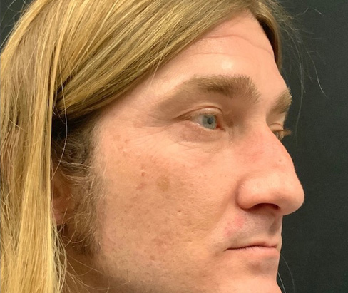 42 year old male 7 months after rhinoplasty