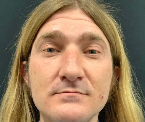 42 year old male shown 3 months sp closed rhinoplasty 42 year old male shown 3 months sp closed rhinoplasty