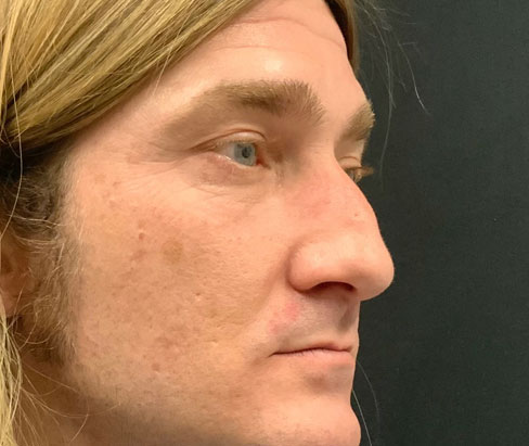 42 year old male shown 3 months sp closed rhinoplasty