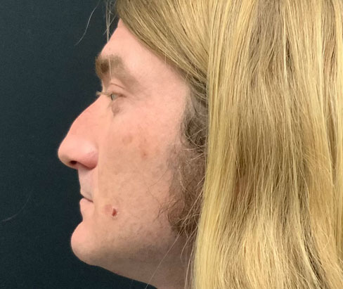 42 year old male shown 3 months sp closed rhinoplasty