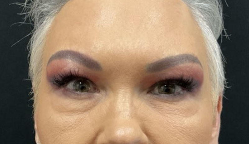 upper blepharoplasty before and after image