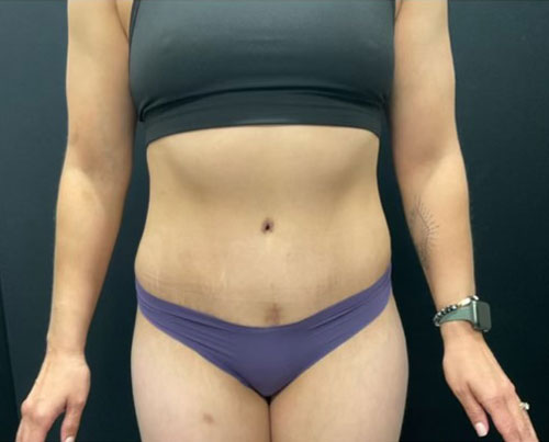 36 year old woman shown 4 months after abdominoplasty with 360 degree liposuction