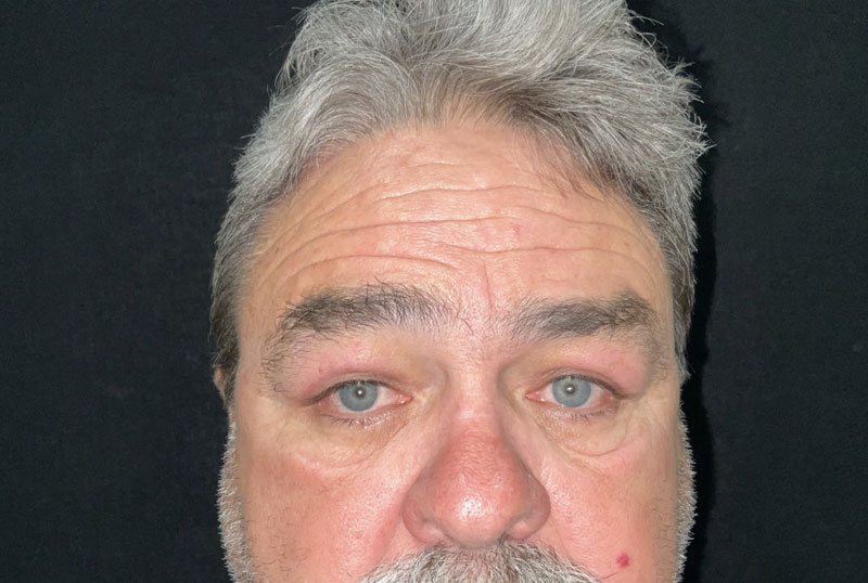 Male blepharoplasty and brow lift are customized to fit the masculine facial characteristics. In this gentleman, shown before and 3 months after surgery,Dr.Ilya Leyngold performed upper and lower blepharoplasty (upper and lower lid surgery) with conservative skin excision and endoscopic brow lift. Notice the preservation of the flat brow contour.