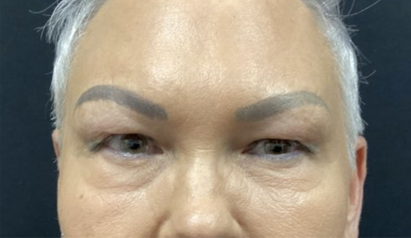 upper blepharoplasty before and after image