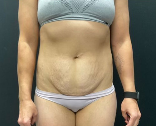 36 year old woman shown 4 months after abdominoplasty with 360 degree liposuction