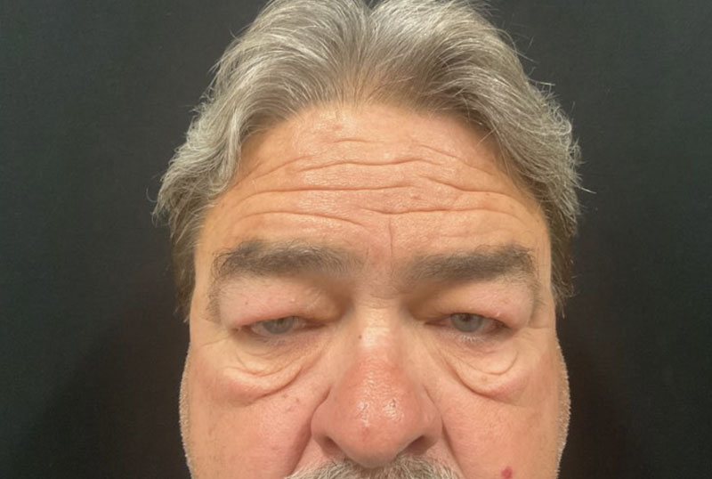 Male blepharoplasty and brow lift are customized to fit the masculine facial characteristics. In this gentleman, shown before and 3 months after surgery,Dr.Ilya Leyngold performed upper and lower blepharoplasty (upper and lower lid surgery) with conservative skin excision and endoscopic brow lift. Notice the preservation of the flat brow contour.