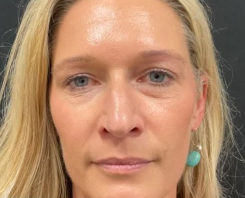 37-year-old female 6 weeks after closed rhinoplasty