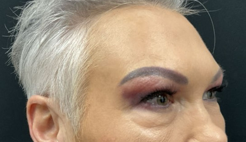 upper blepharoplasty before and after image