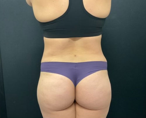 36 year old woman shown 4 months after abdominoplasty with 360 degree liposuction