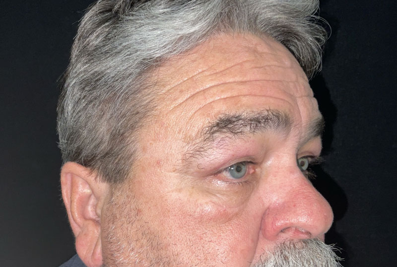 Male blepharoplasty and brow lift are customized to fit the masculine facial characteristics. In this gentleman, shown before and 3 months after surgery,Dr.Ilya Leyngold performed upper and lower blepharoplasty (upper and lower lid surgery) with conservative skin excision and endoscopic brow lift. Notice the preservation of the flat brow contour.