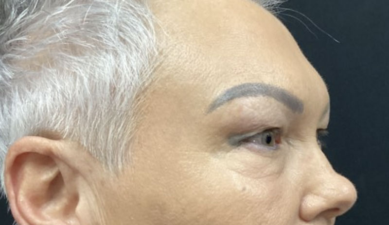 upper blepharoplasty before and after image