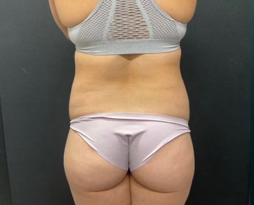 36 year old woman shown 4 months after abdominoplasty with 360 degree liposuction