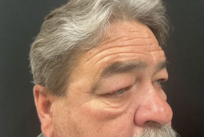 Male blepharoplasty and brow lift are customized to fit the masculine facial characteristics. In this gentleman, shown before and 3 months after surgery,Dr.Ilya Leyngold performed upper and lower blepharoplasty (upper and lower lid surgery) with conservative skin excision and endoscopic brow lift. Notice the preservation of the flat brow contour.