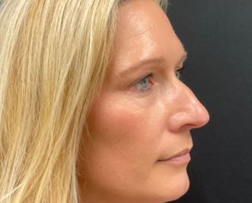 37-year-old female 6 weeks after closed rhinoplasty