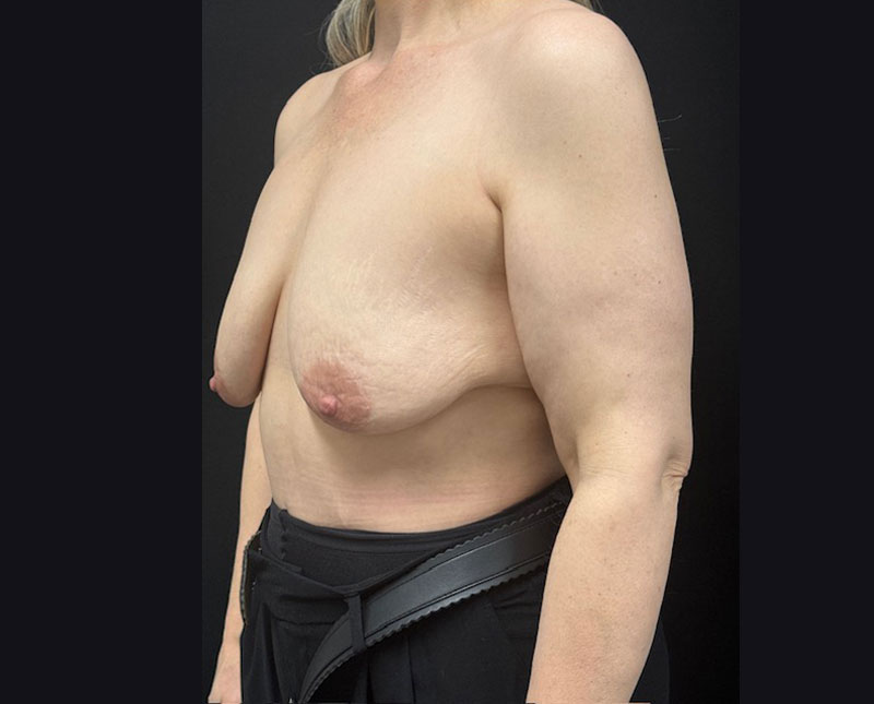 A woman in her 40s after bilateral mastopexy and subfascial breast augmentation with moderate profile Sientra implants