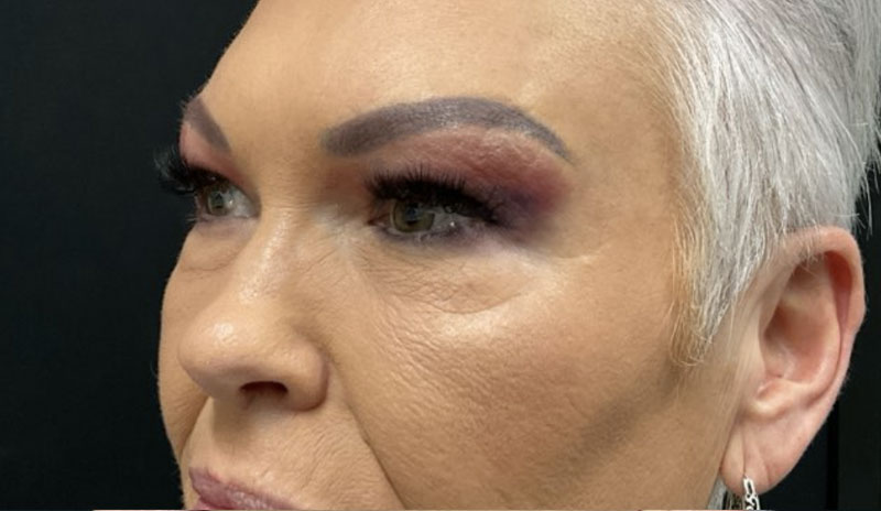 upper blepharoplasty before and after image