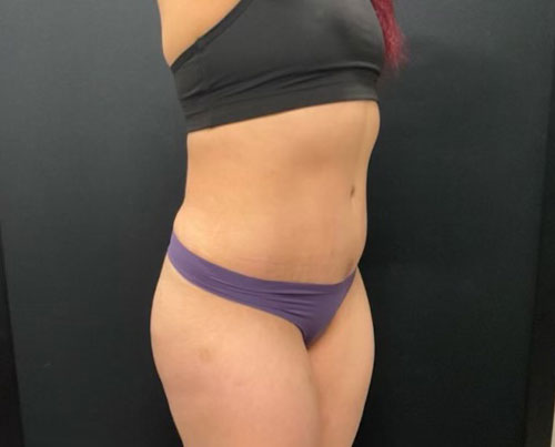 36 year old woman shown 4 months after abdominoplasty with 360 degree liposuction