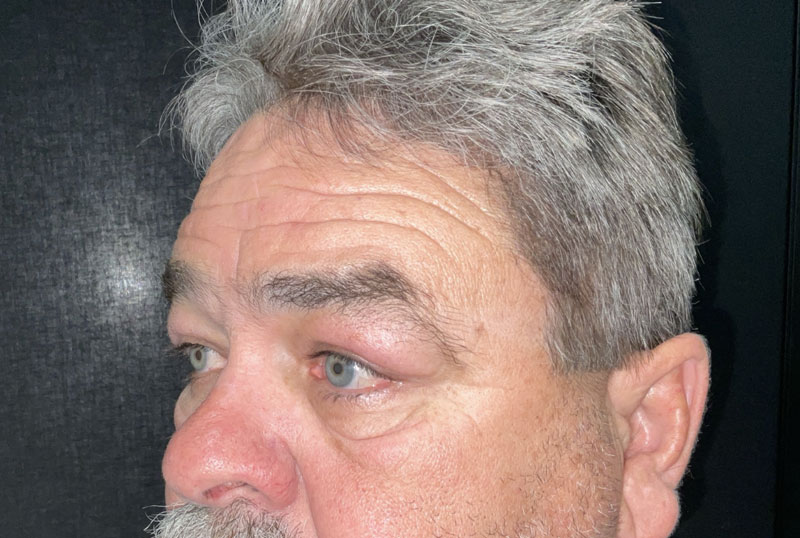 Male blepharoplasty and brow lift are customized to fit the masculine facial characteristics. In this gentleman, shown before and 3 months after surgery,Dr.Ilya Leyngold performed upper and lower blepharoplasty (upper and lower lid surgery) with conservative skin excision and endoscopic brow lift. Notice the preservation of the flat brow contour.