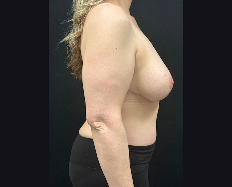 A woman in her 40s after bilateral mastopexy and subfascial breast augmentation with moderate profile Sientra implants