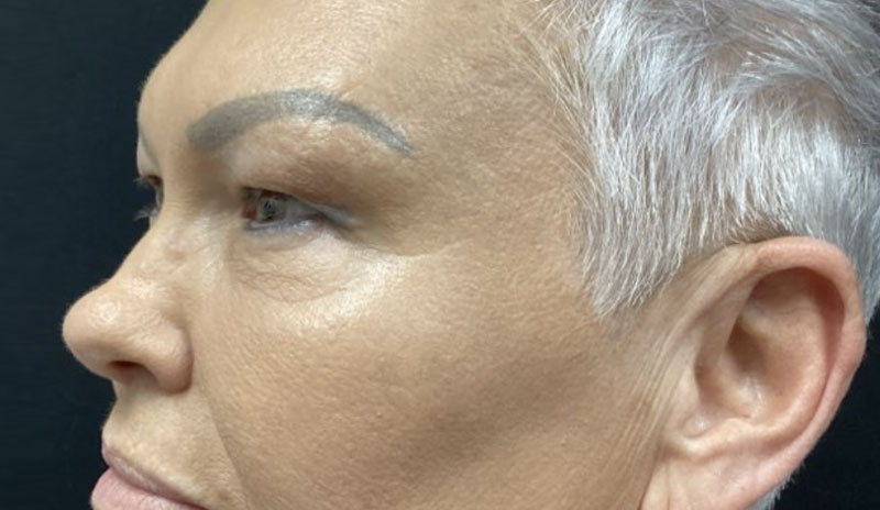 upper blepharoplasty before and after image