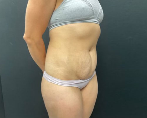 36 year old woman shown 4 months after abdominoplasty with 360 degree liposuction