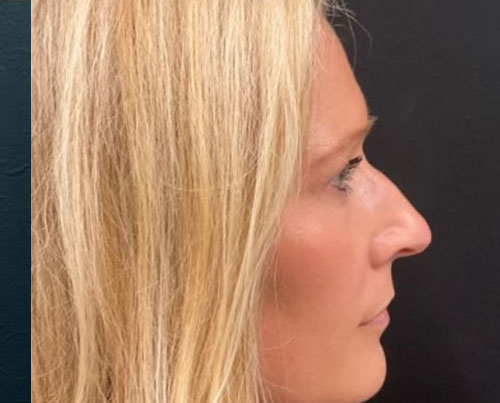 37-year-old female 6 weeks after closed rhinoplasty