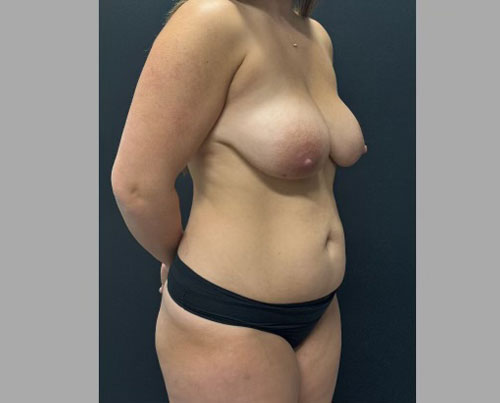 32 year old female 3 months after a “mommy makeover”. Her surgery consisted of full abdominoplasty, 360 degree liposuction, fat grafting to hip dips, bilateral subfascial breast augmentation with low profile implants and mastopexy.